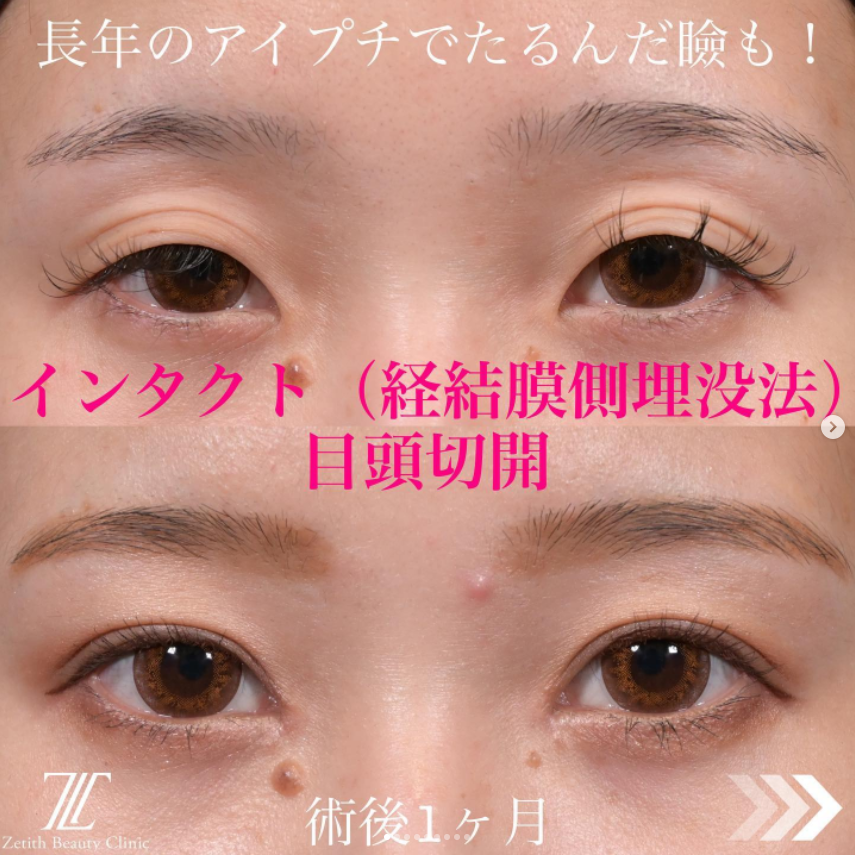 《術後1ヶ月》上木原医師による目頭切開＋二重埋没法（インタクト）