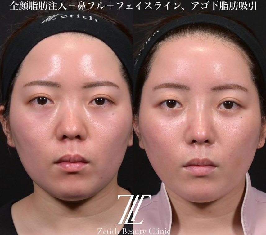 鉄医師による鼻のフルコースの施術前／施術後2週間