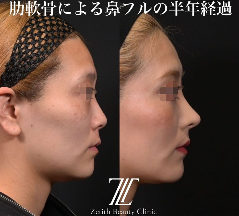 鉄医師による鼻のフルコースの施術前／施術後6ヶ月