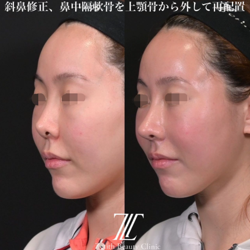 鉄医師による鼻のフルコースの施術前／施術後1ヶ月 施術後 