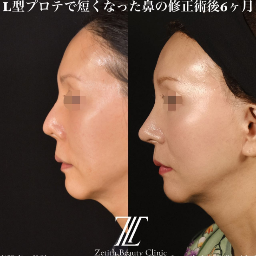 鉄医師による鼻のフルコースの施術前／施術後6ヶ月