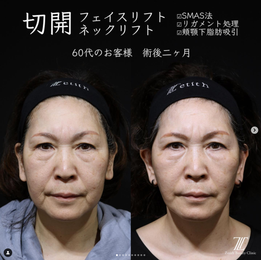 《術後2ヶ月》王医師によるフェイスリフト＋ネックリフト