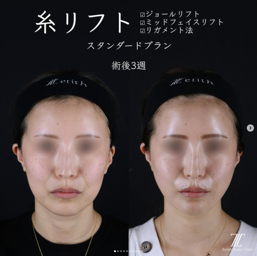 《術後3週間》王医師による糸リフト