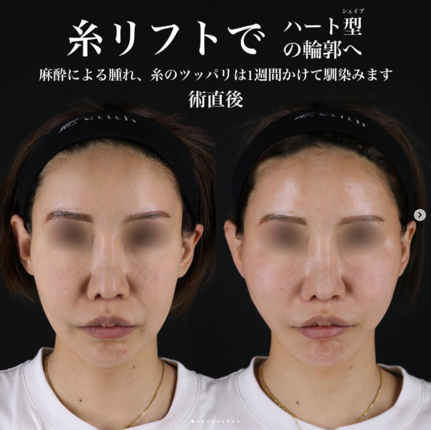 《術直後》王医師による糸リフト