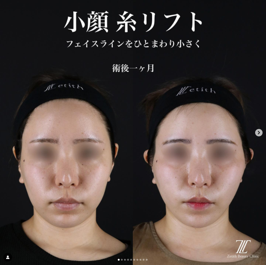 《術後1ヶ月》王医師による糸リフト