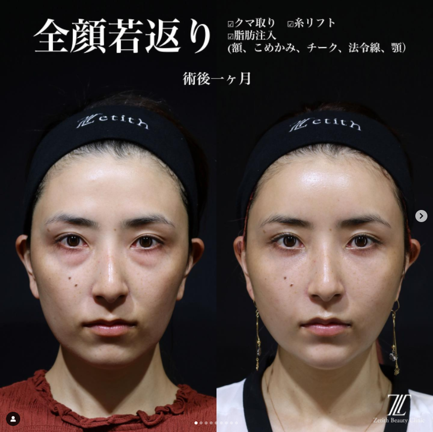 《術後1ヶ月》王医師によるクマ取り＋脂肪注入＋糸リフト