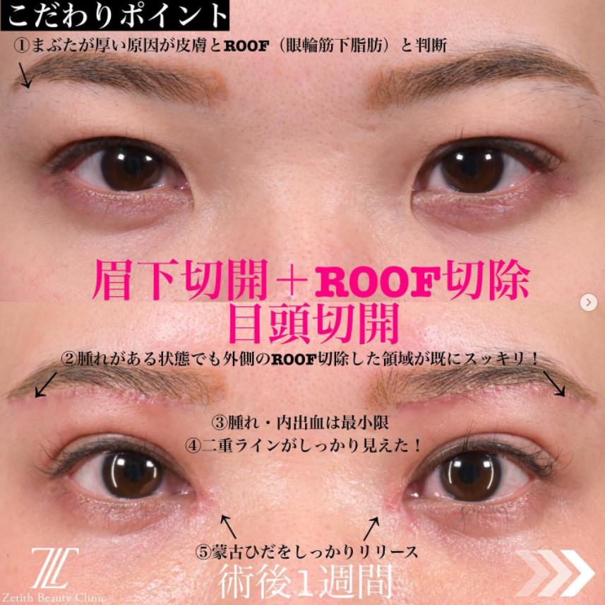 《術後1ヶ月》上木原医師による眉下切開＋ROOF切除＋目頭切開