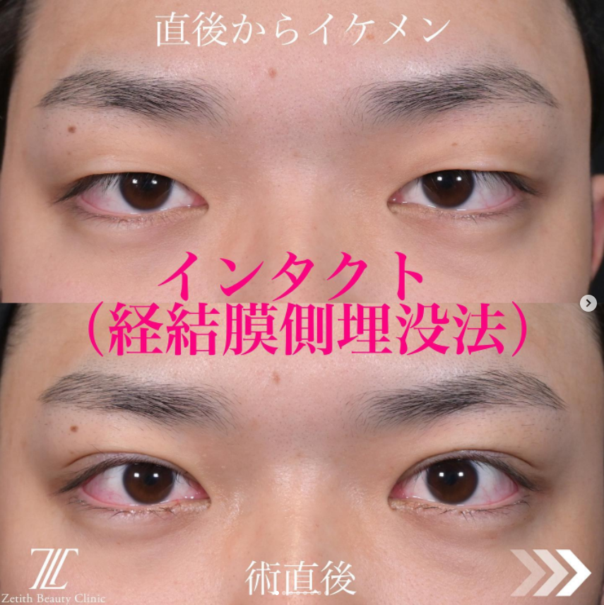 《術直後》上木原医師による二重埋没法