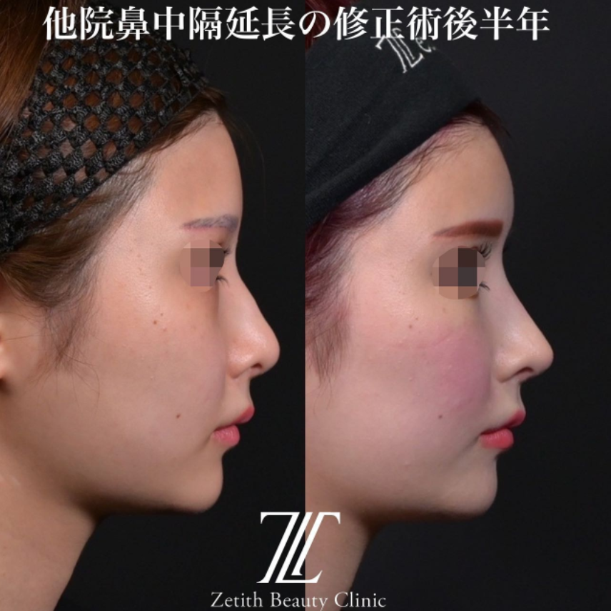 鉄医師による鼻のフルコースの施術前／施術後6ヶ月