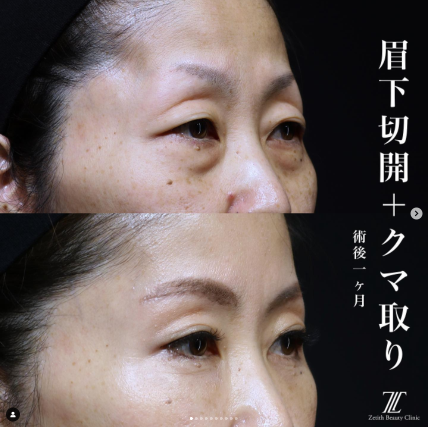 《術後1ヶ月》王医師による眉下切開＋クマ取り Дараа 