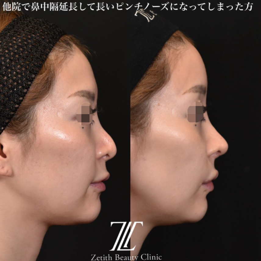 鉄医師による鼻のフルコースの施術前／施術後3ヶ月 术后 