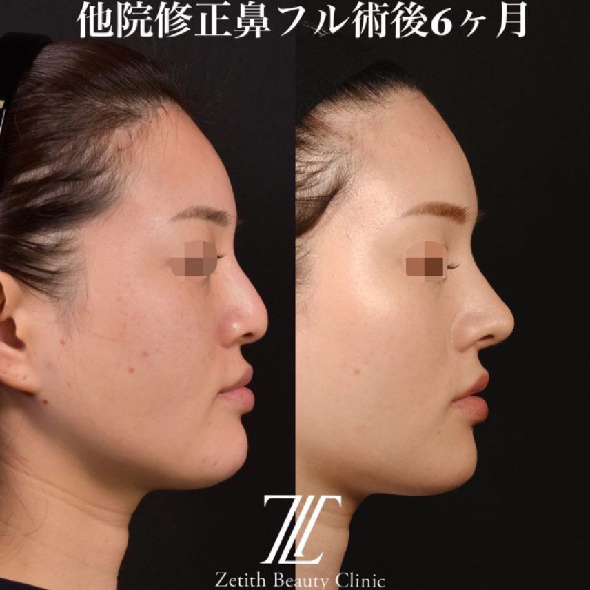 鉄医師による鼻のフルコースの施術前／施術後6ヶ月 施術後 