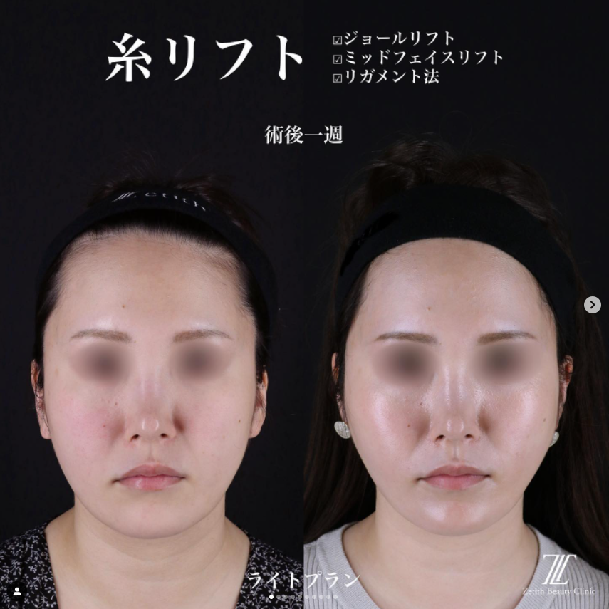 《術後1週間》王医師による糸リフト
