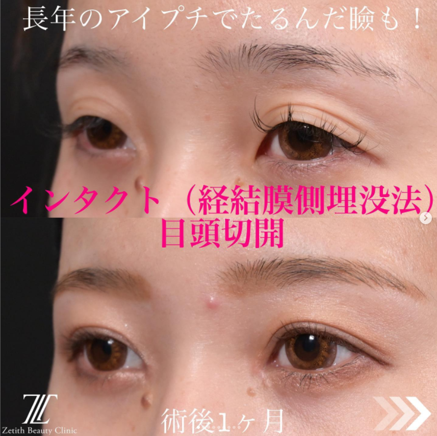 《術後1ヶ月》上木原医師による目頭切開＋二重埋没法（インタクト） Дараа 