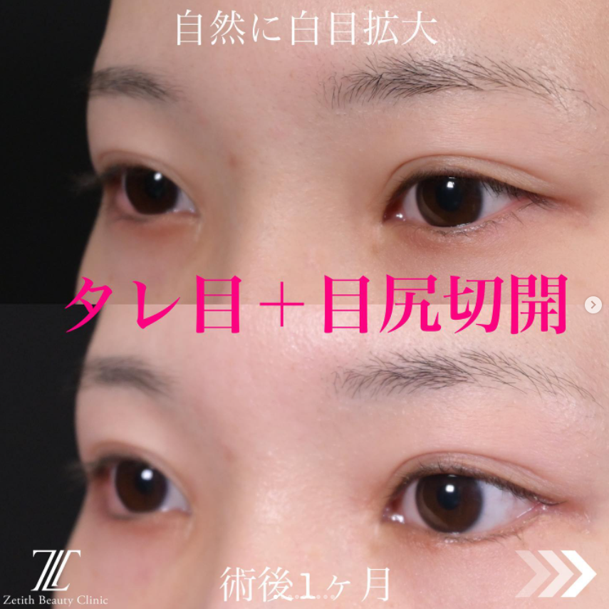 《術後》 术后 
