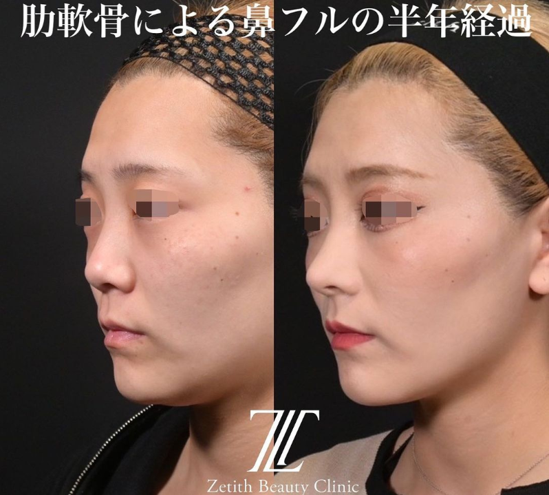 鉄医師による鼻のフルコースの施術前／施術後6ヶ月 หลัง 