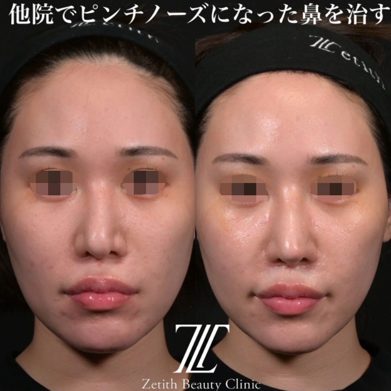 鉄医師による鼻のフルコースの施術前／施術後2週間 施術後 