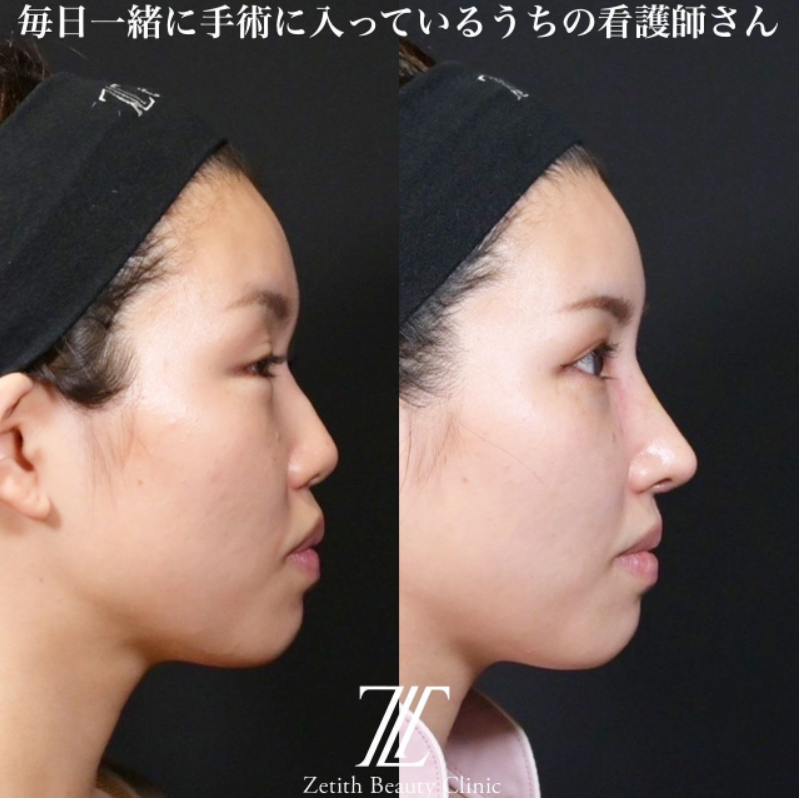 鉄医師による鼻のフルコースの施術前／施術後2週間