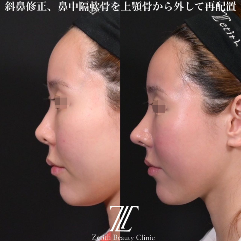 鉄医師による鼻のフルコースの施術前／施術後1ヶ月