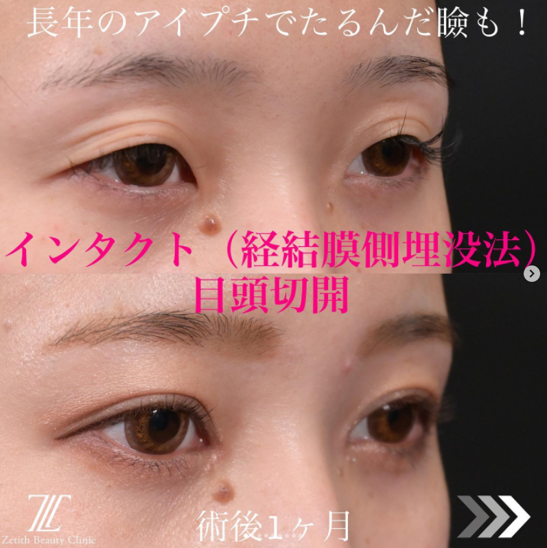 《術後1ヶ月》上木原医師による二重埋没法＋目頭切開 施術後 