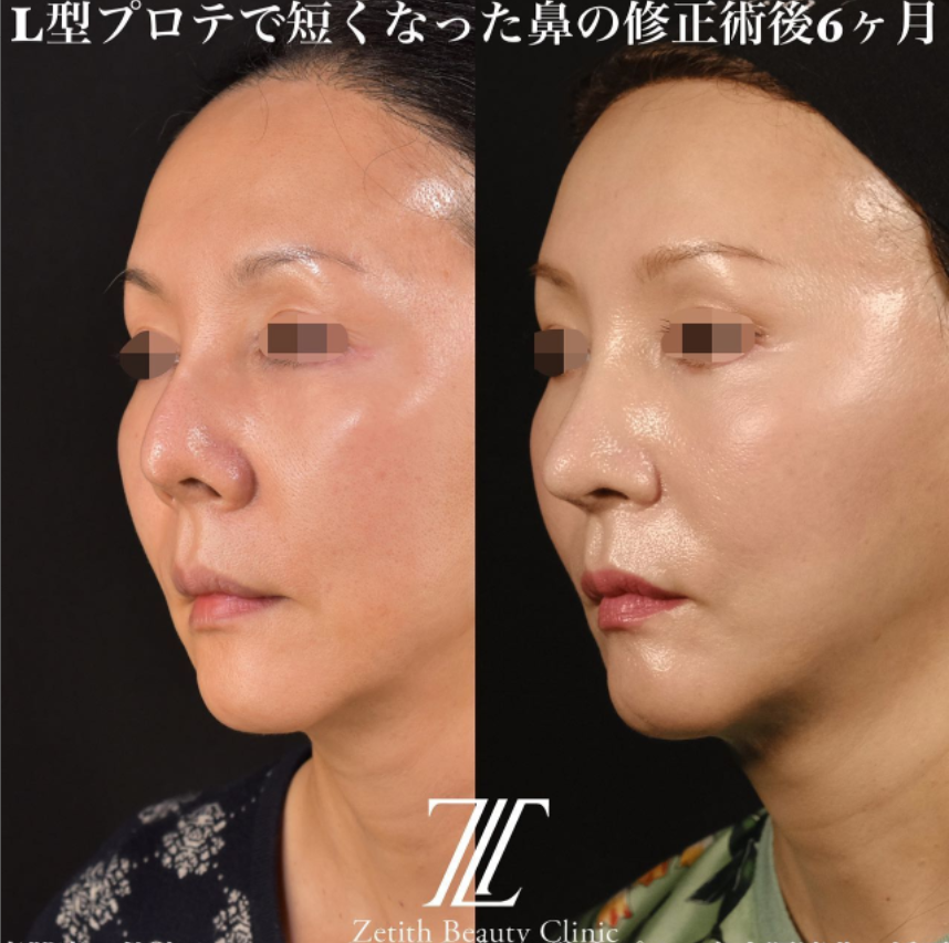 鉄医師による鼻のフルコースの施術前／施術後6ヶ月 术后 