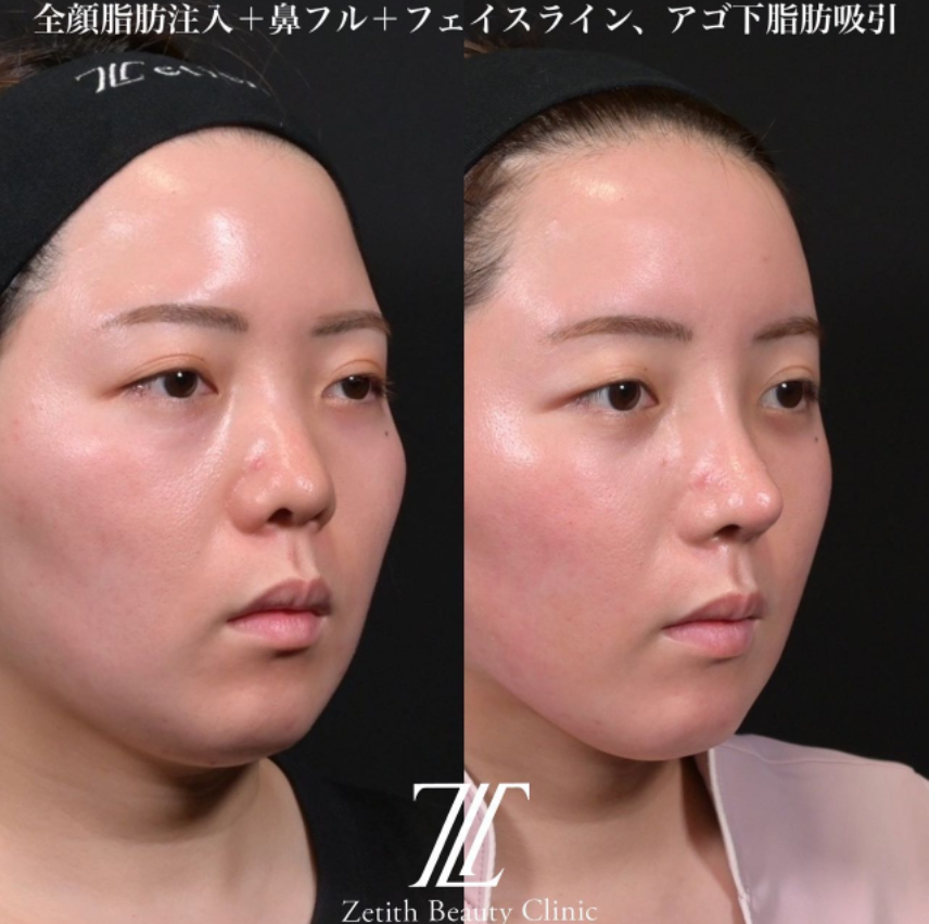 鉄医師による鼻のフルコースの施術前／施術後2週間 หลัง 