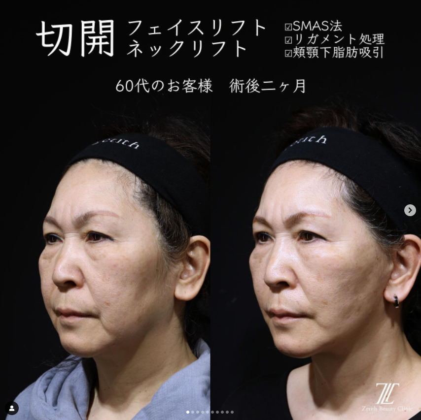 《術後2ヶ月》王医師によるフェイスリフト＋ネックリフト بعد 