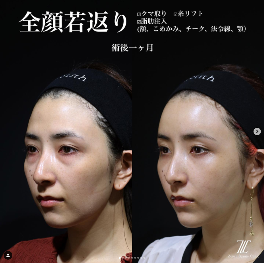 《術後1ヶ月》王医師によるクマ取り＋脂肪注入＋糸リフト หลัง 