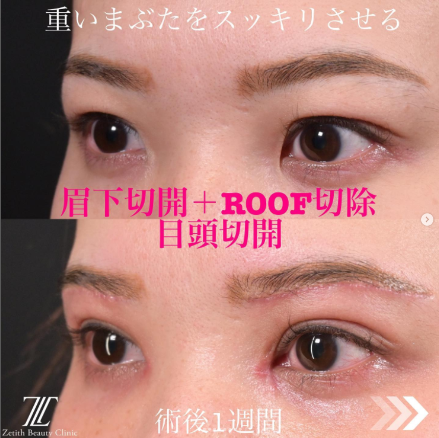 《術後1ヶ月》上木原医師による眉下切開＋ROOF切除＋目頭切開 หลัง 