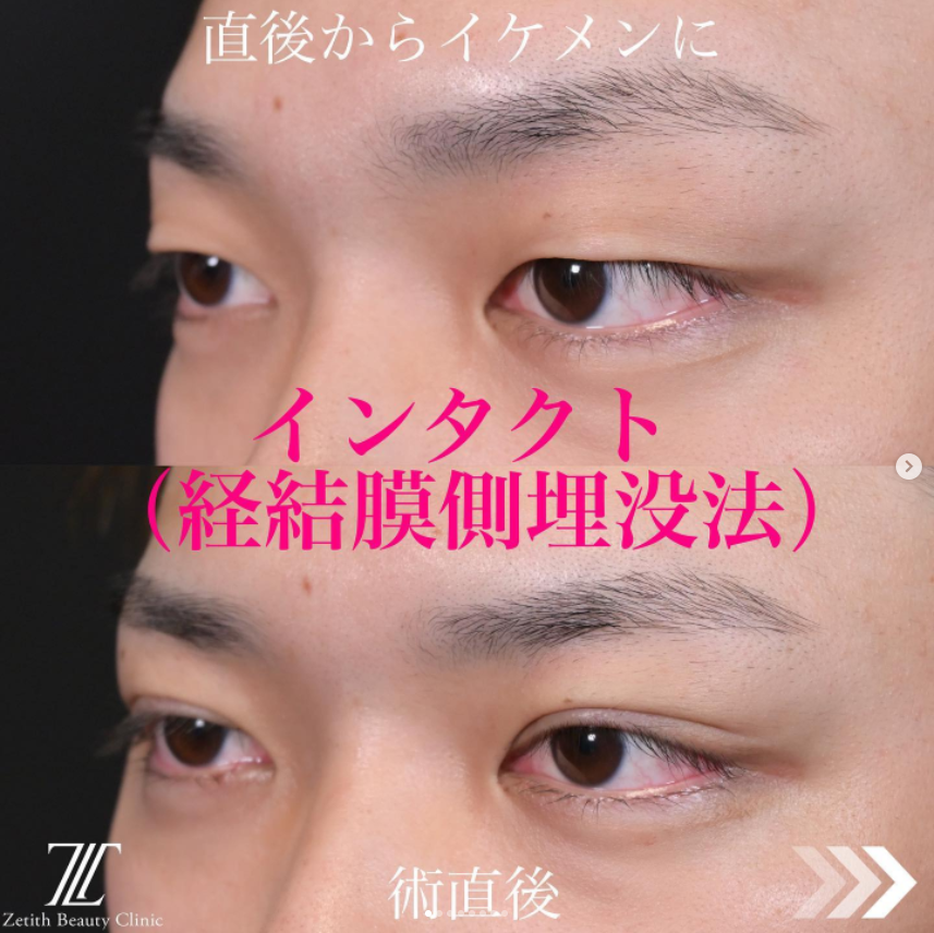 《術直後》上木原医師による二重埋没法 หลัง 