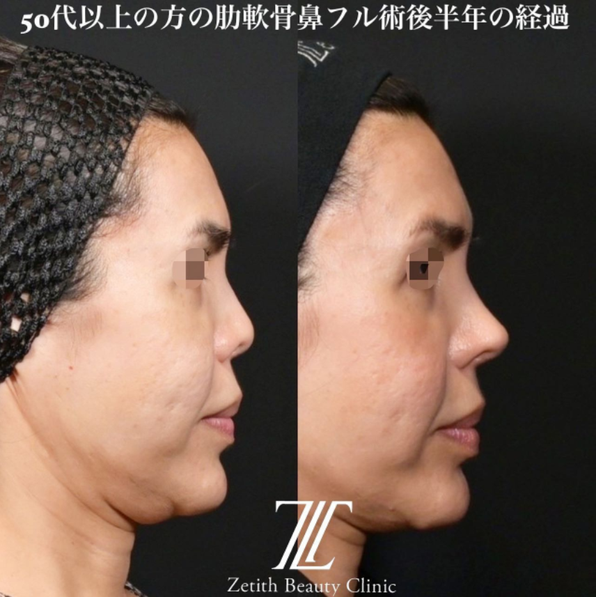 鉄医師による鼻のフルコースの施術前／施術後6ヶ月 After 