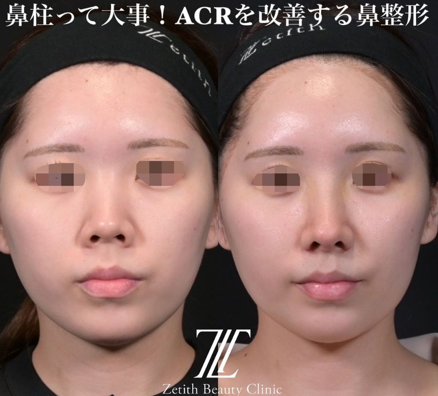 鉄医師による鼻のフルコースの施術前／施術後2週間
