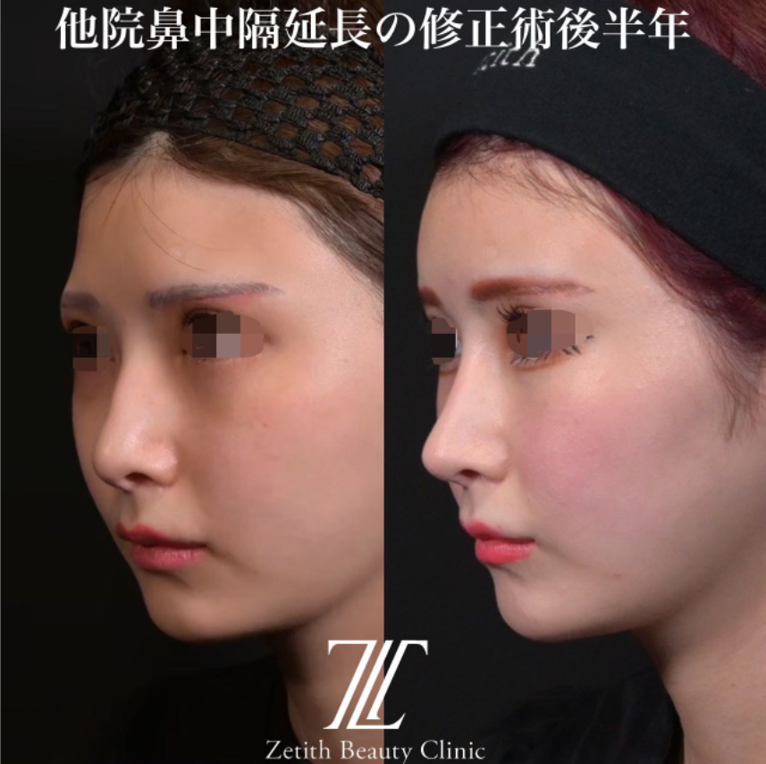 鉄医師による鼻のフルコースの施術前／施術後6ヶ月 施術後 