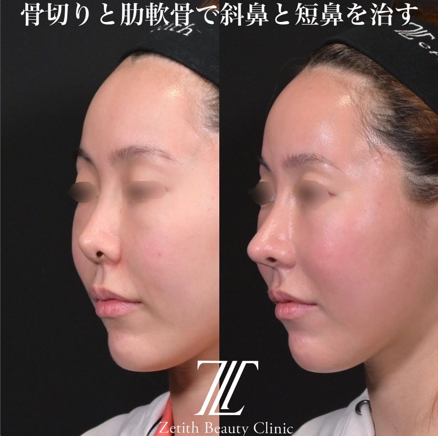 鉄医師による鼻のフルコースの施術前／施術後
