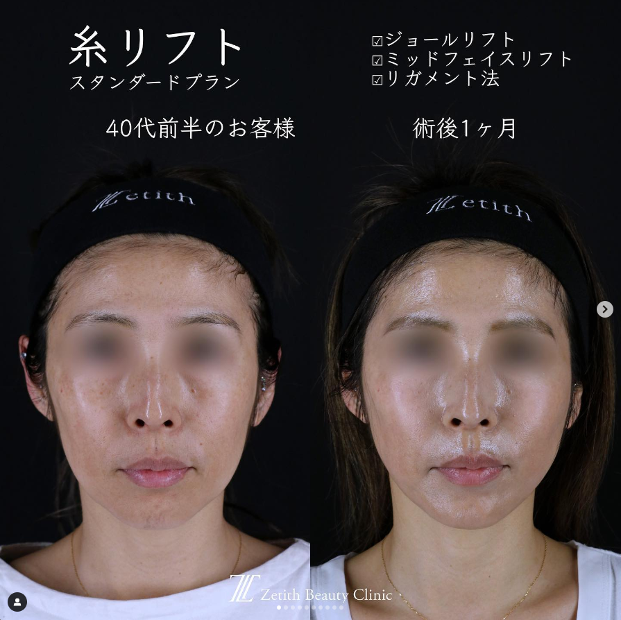 《術後1ヶ月》王医師による糸リフト