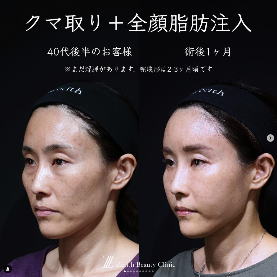 《術後1ヶ月》王医師による糸リフト＋脂肪注入（全顔）