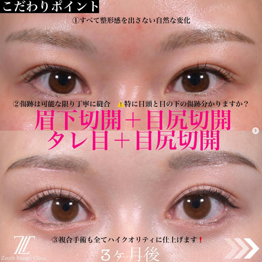 《術後3か月》上木原医師による眉下切開＋目頭切開＋目尻切開＋タレ目形成