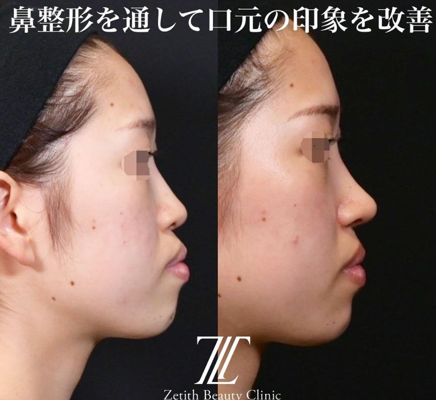 鉄医師による鼻のフルコースの施術前／施術後1ヶ月
