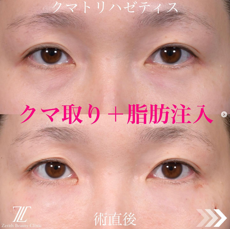 《術直後》上木原医師によるクマ取り＋脂肪注入