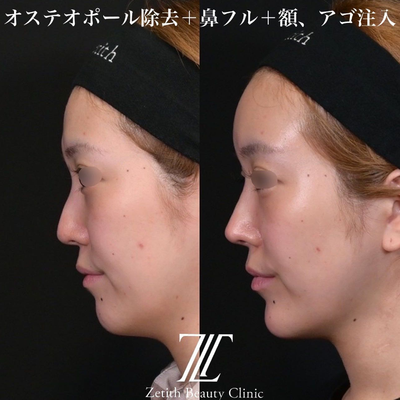 鉄医師による鼻のフルコースの施術前／施術後1ヶ月