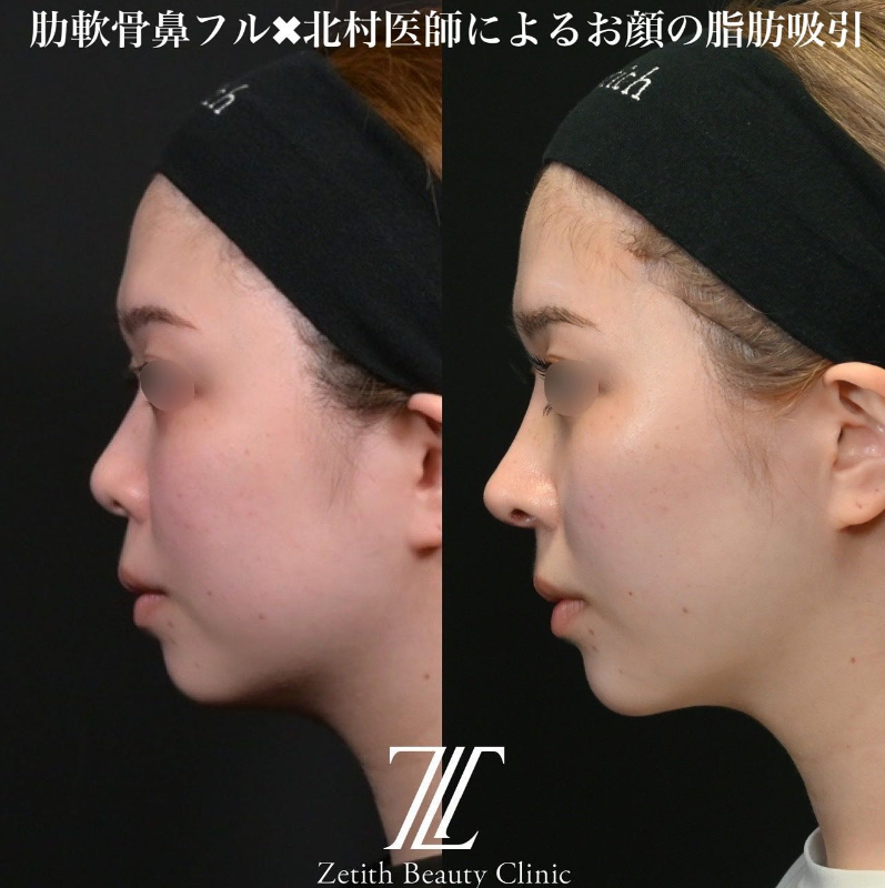 鉄医師による鼻のフルコースの施術前／施術後1ヶ月