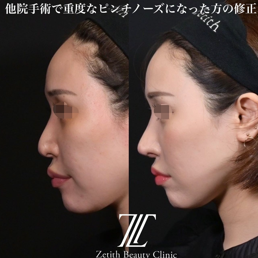 鉄医師による鼻のフルコースの施術前／施術後1ヶ月