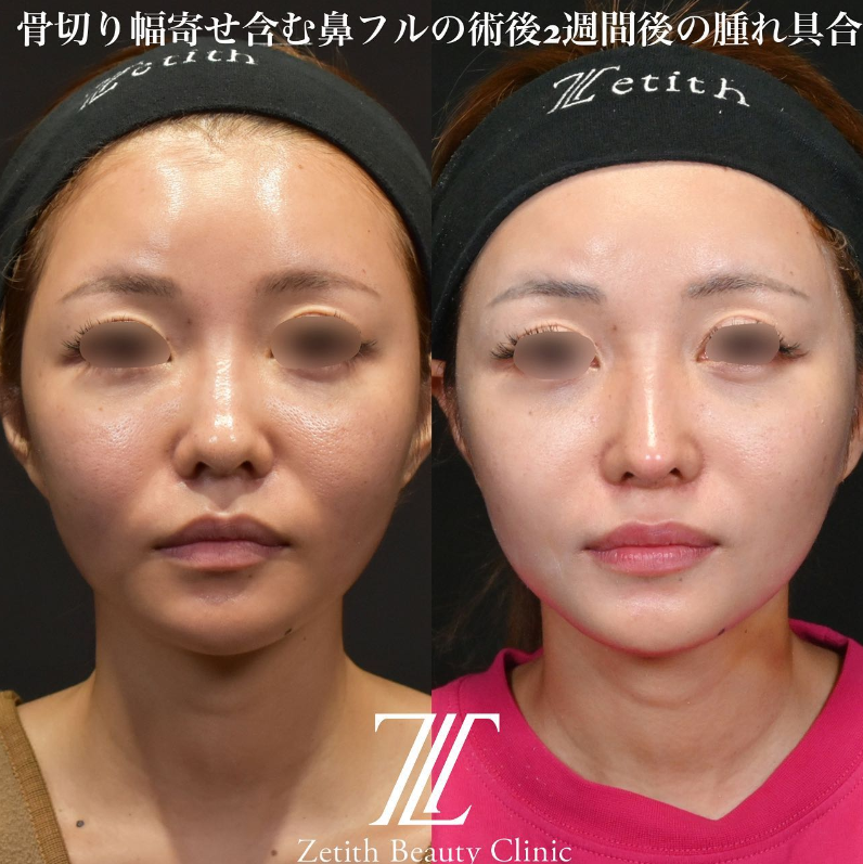 鉄医師による鼻のフルコースの施術前／施術後2週間