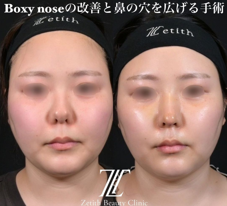 鉄医師による鼻のフルコースの施術前／施術後1週間