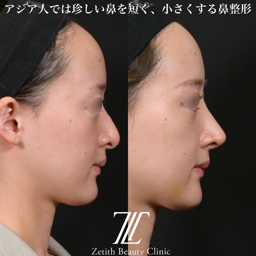 鉄医師による鼻のフルコースの施術前／施術後2週間