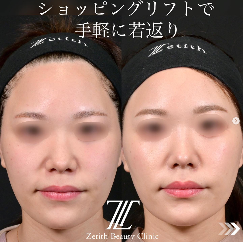 《術後2週間》北村医師によるショッピングリフト