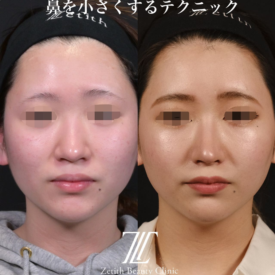 鉄医師による鼻のフルコースの施術前／施術後3ヶ月