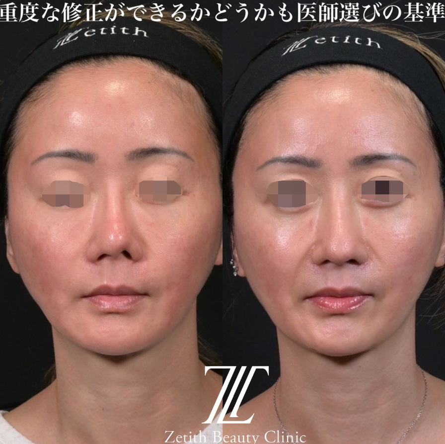 鉄医師による鼻のフルコースの施術前／施術後1ヶ月