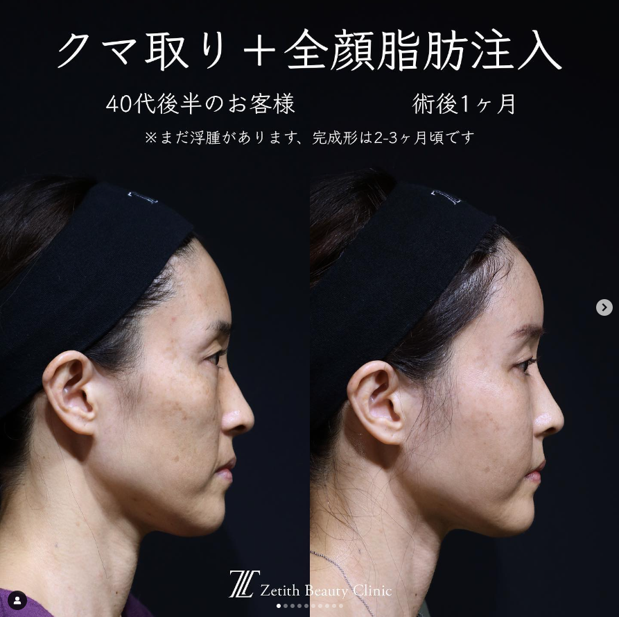 《術後1ヶ月》王医師による糸リフト＋脂肪注入（全顔） Sonra 