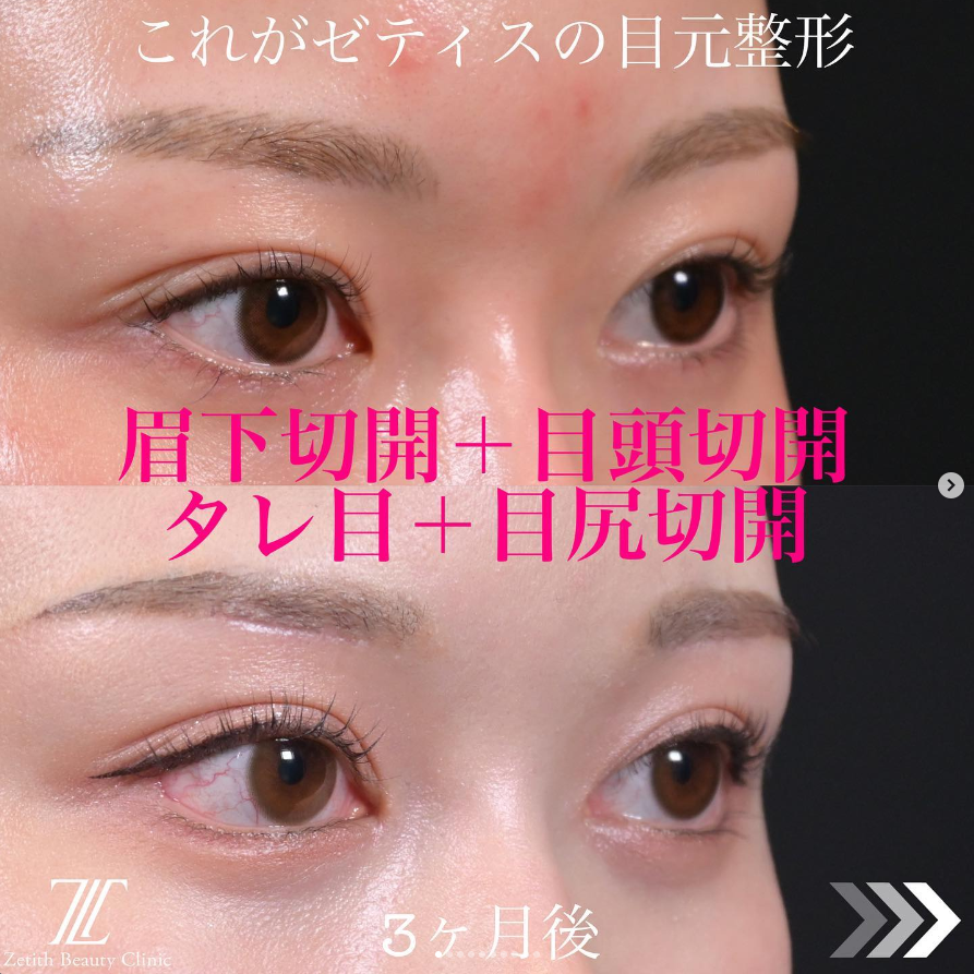 《術後3か月》上木原医師による眉下切開＋目頭切開＋目尻切開＋タレ目形成 施術後 